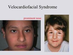 velocardiofacial syndrome facial features